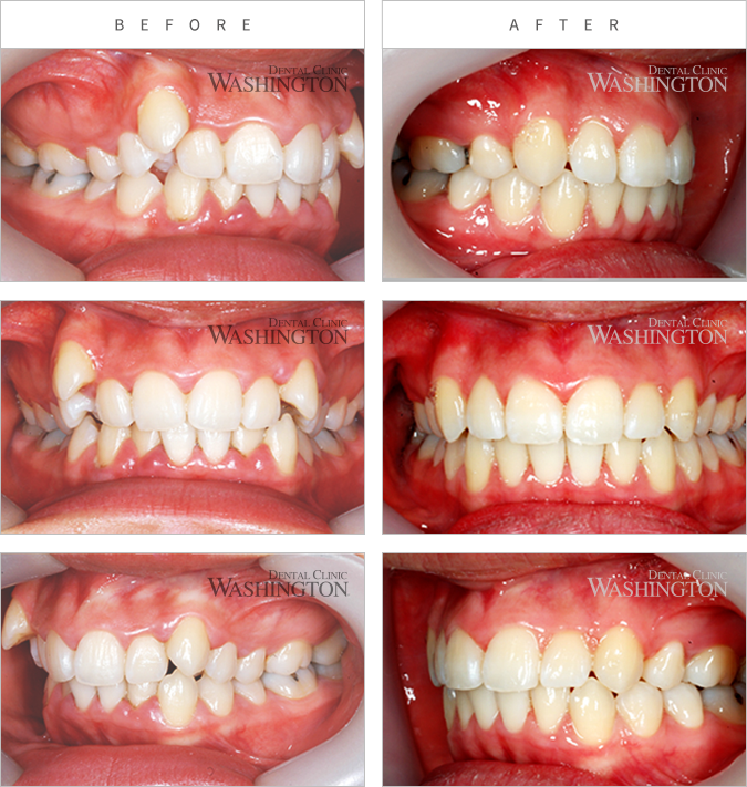 치아교정 Before & After