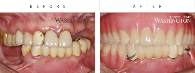 임플란트 Before & After