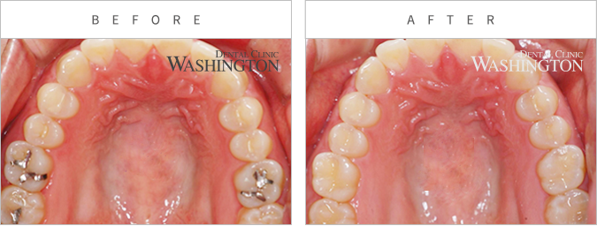 충치/신경치료 Before & After