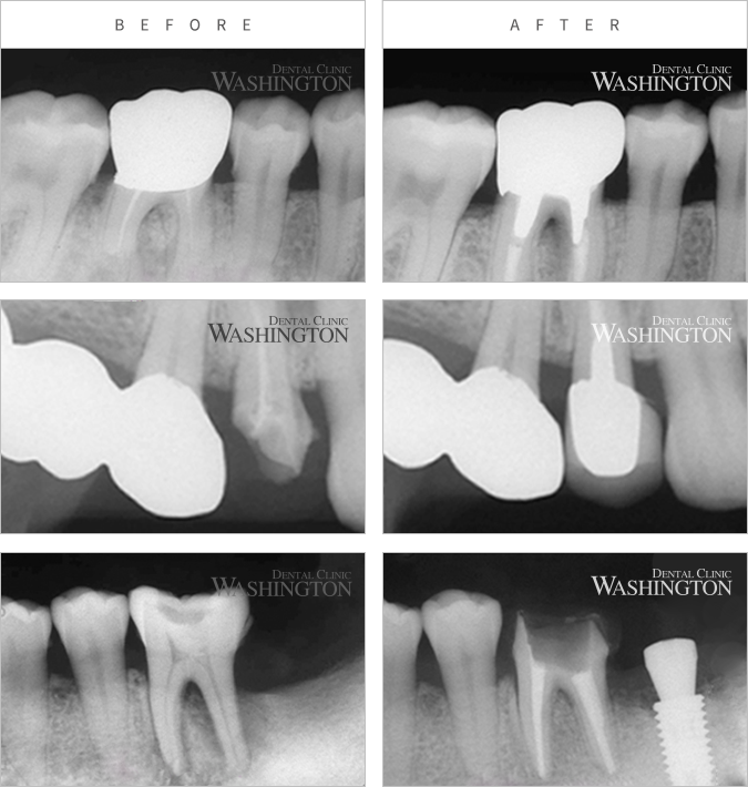 충치/신경치료 Before & After