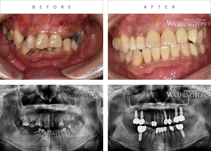 임플란트 Before & After