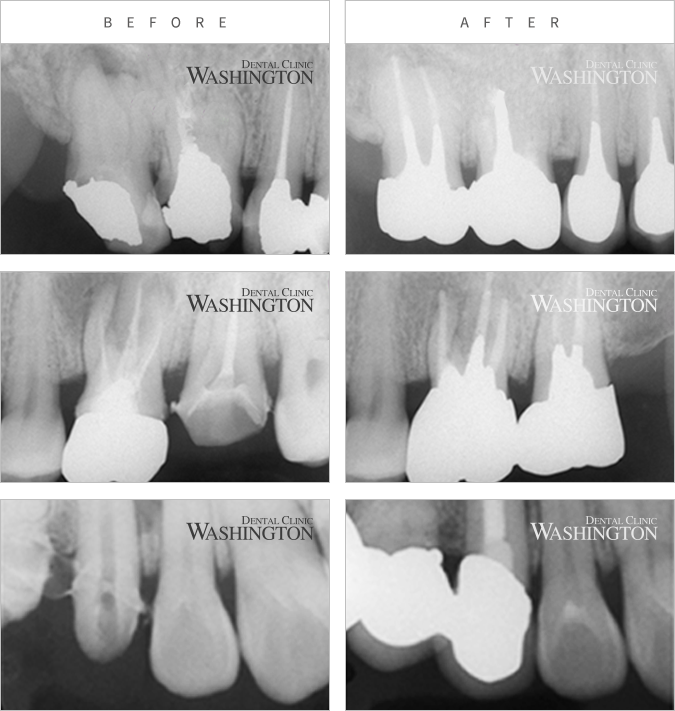 충치/신경치료 Before & After