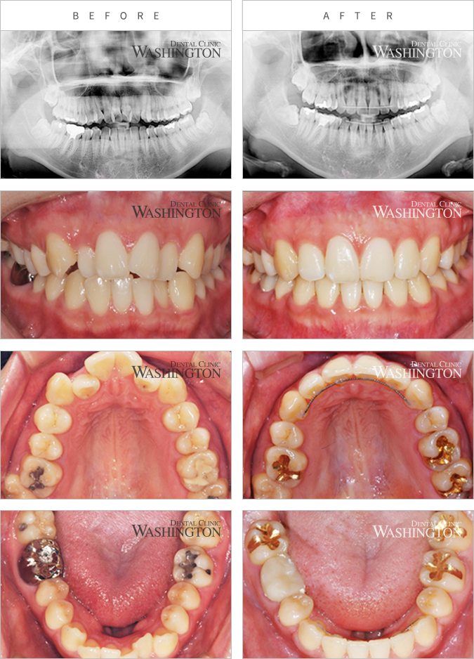 치아교정 Before & After