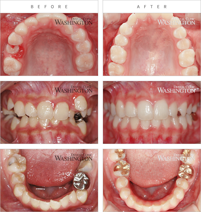 치아교정 Before & After