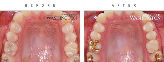 충치/신경치료 Before & After