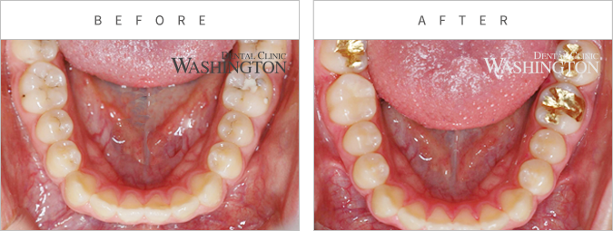 충치/신경치료 Before & After
