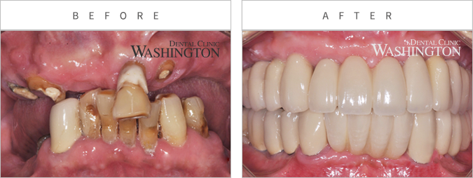 임플란트 Before & After