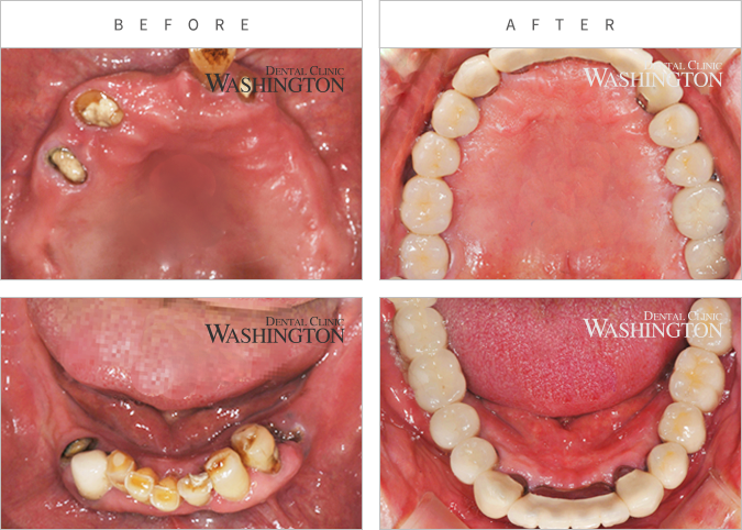 임플란트 Before & After