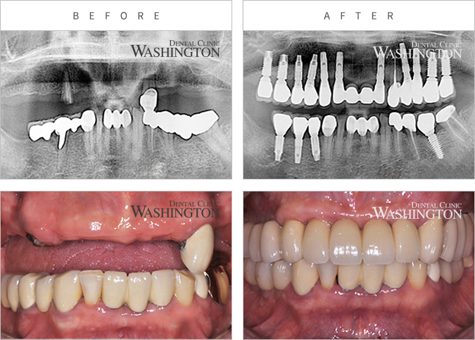 임플란트 Before & After