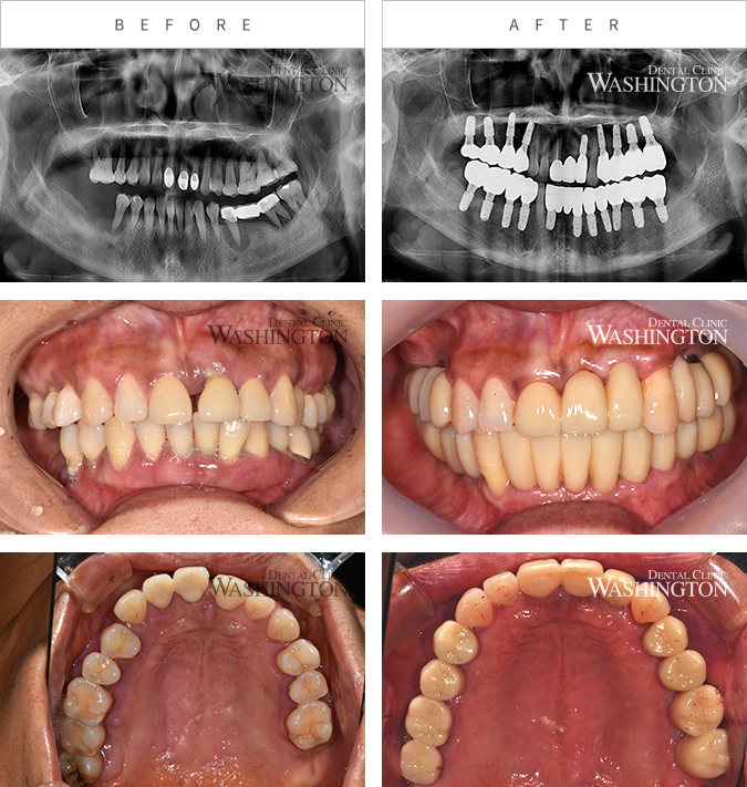 임플란트 Before & After