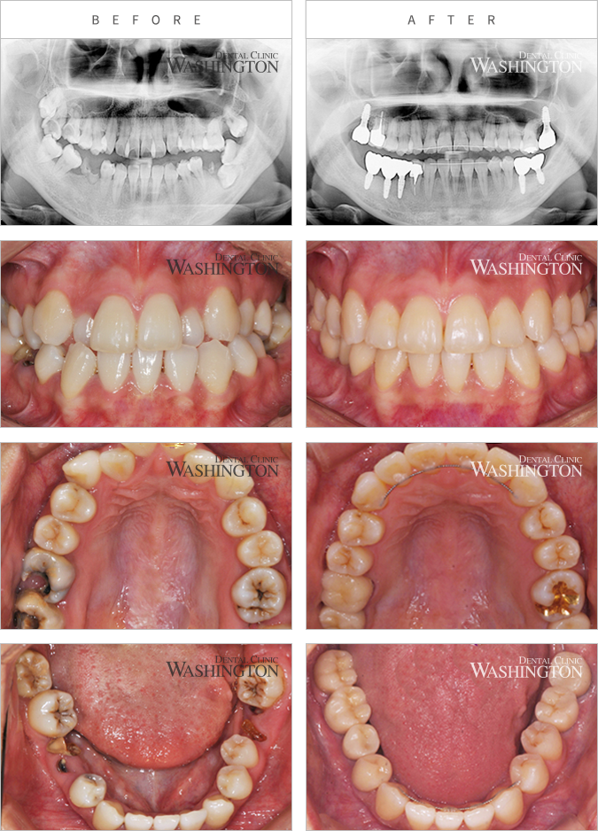 치아교정 Before & After