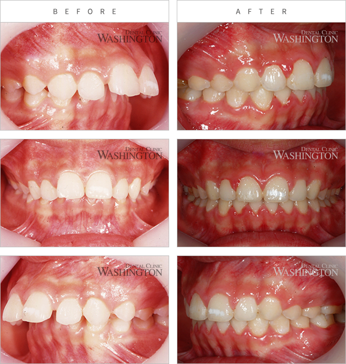 치아교정 Before & After