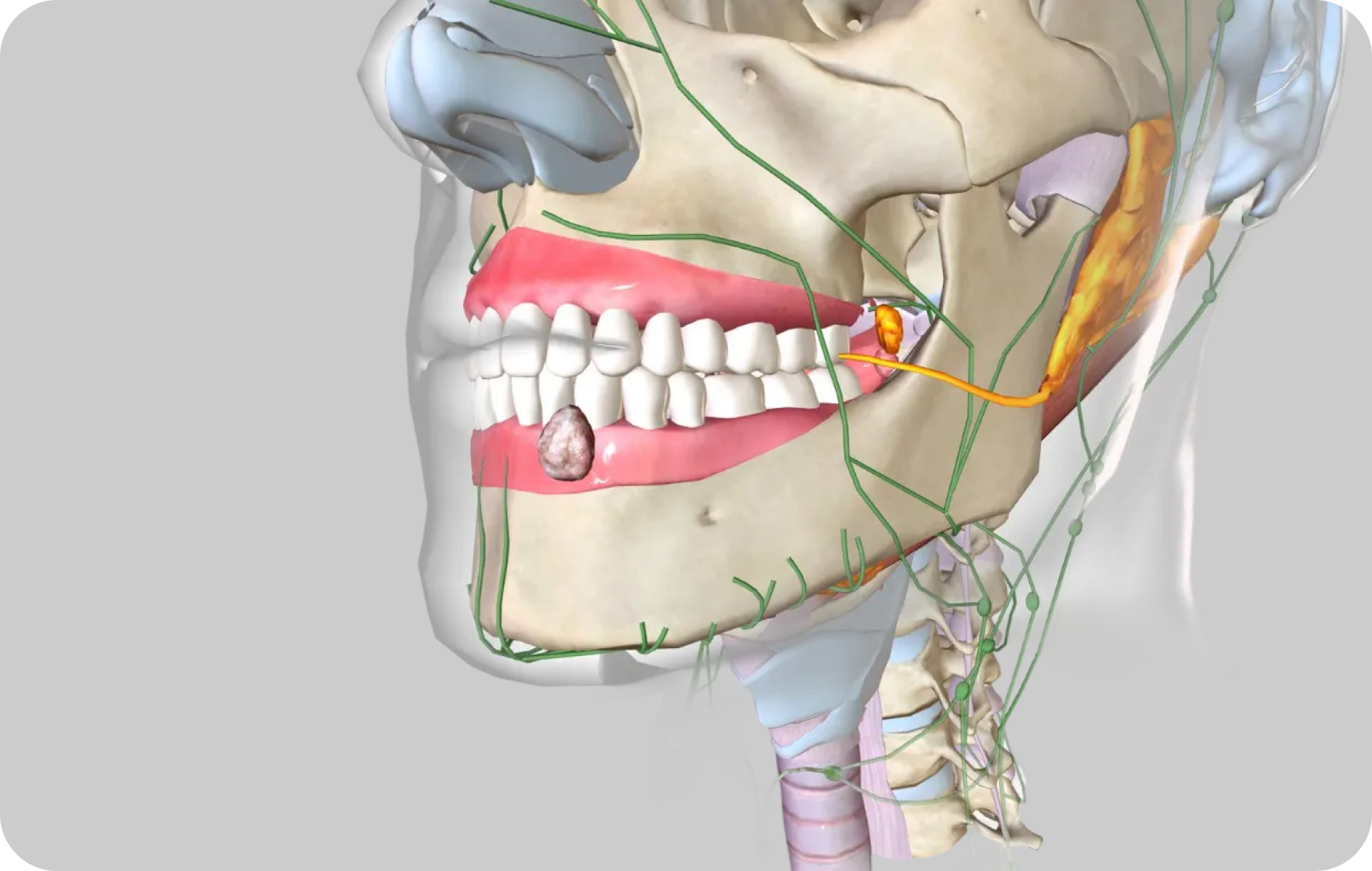 M치과 뼈이식 임플란트란?