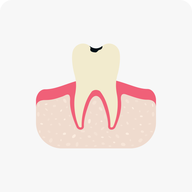 표면 초기 충치