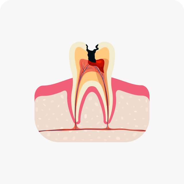 신경 괴사 및 뿌리 손상