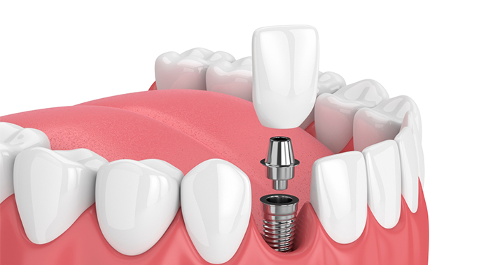 심미 임플란트 3D 일러스트