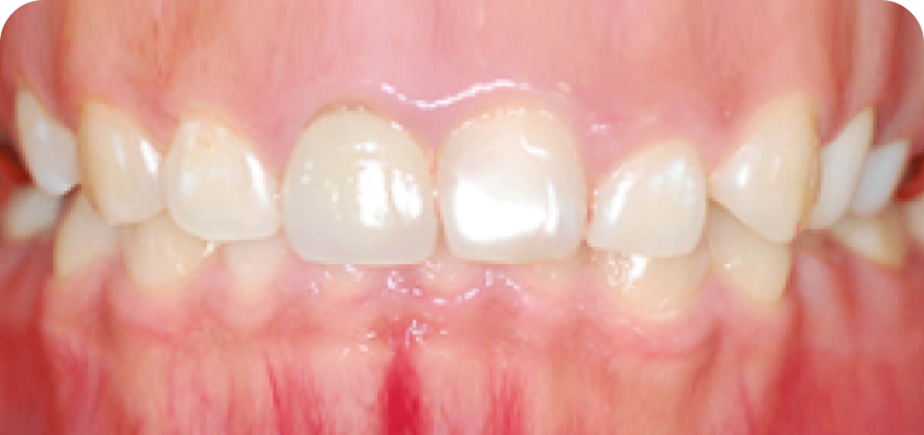 스마일 라인 불균형