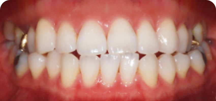 좌우 잇몸 높이 불균형