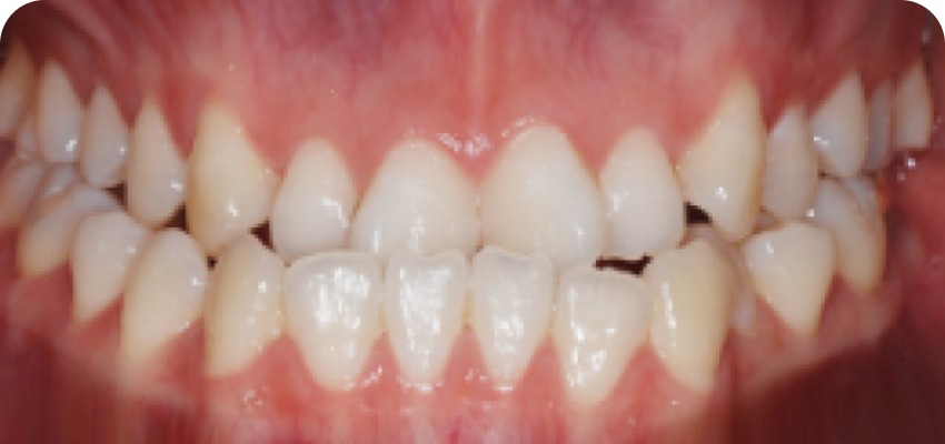 치아 길이가 짧은 경우