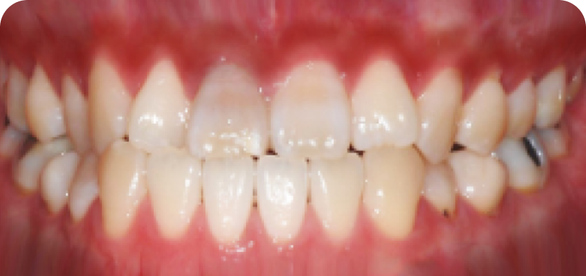 잇몸 색소 침착