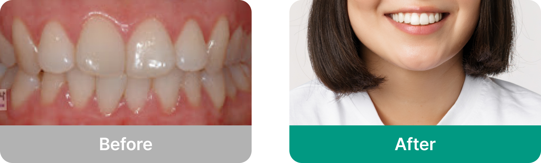 잇몸성형 전후 비교