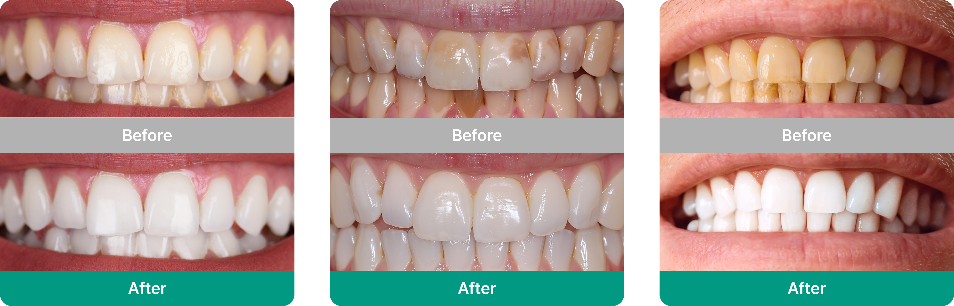 치아미백 전후 비교